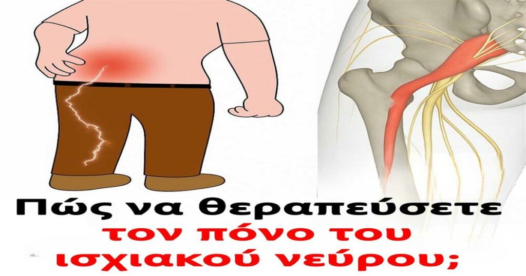 3 ασκήσεις για την ανακούφιση από τον ισχιαλγικό πόνο στο πόδι: πρακτικές και αποτελεσματικές
