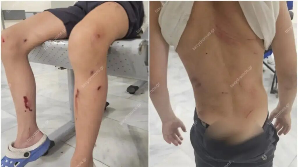 Στο νοσοκομείο 7χρονος μετά από επίθεση σκυλιών – «Παραλίγο να το κατασπαράξουν» λέει η μητέρα του