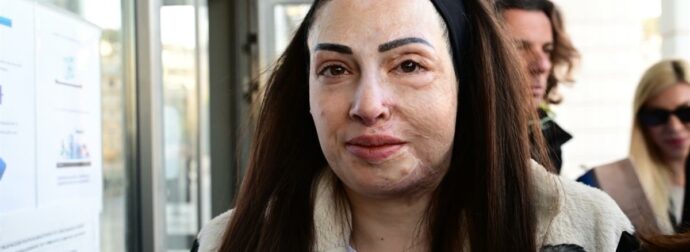 Ιωάννα Παλιοσπύρου: Η συγκλονιστική ανάρτηση για τα σημάδια της επίθεσης με βιτριόλι – «Με ρωτάς πώς αντέχω…»