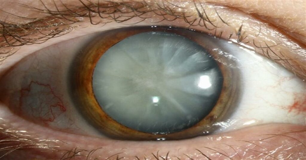 Καταρράκτης ματιών: τι είναι, πρώτα συμπτώματα, επέμβαση και σύγχρονη θεραπεία