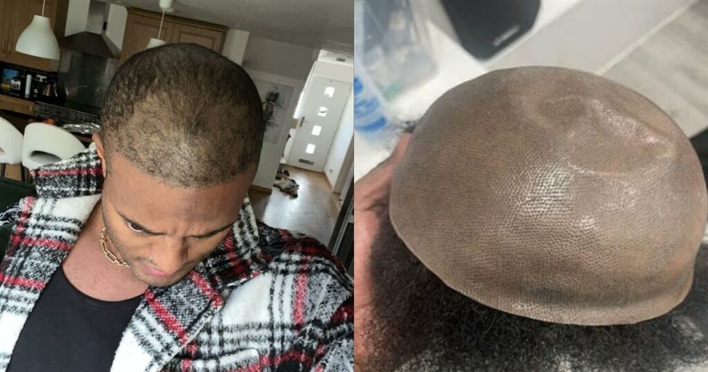 Ο «Mr Tinder» αποκαλύπτει το μεγάλο του μυστικό: Φορούσα περούκες επί 14 χρόνια για να κρύψω την αλήθεια