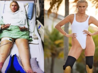 Λόρεν Γουάσερ: Πώς από ένα ταμπόν έχασε και τα δυο της πόδια – Η τραγική ιστορία με το προϊόν που χρησιμοποιεί το 90% των γυναικών