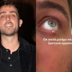 Με αφορμή τον Fipster: Τι είναι το χαλάζιο που τον ταλαιπωρεί – Από τι προκαλείται και πώς αντιμετωπίζεται